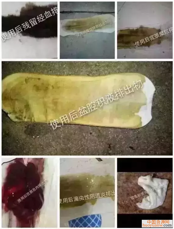 不做手术,轻松治疗妇科疾病!花红雪莲女人私密养护贴